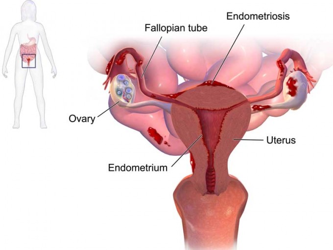 Take 10 Paradigm shift in endometriosis management • The