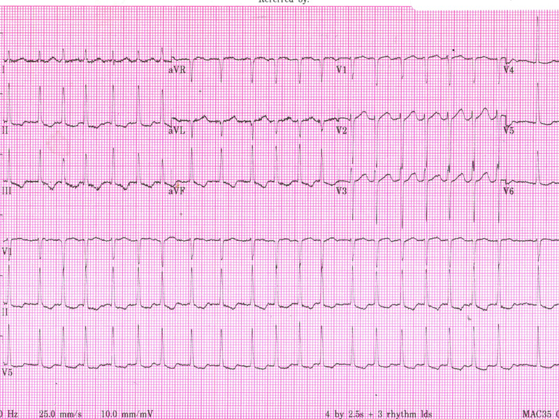 ecg-pic-for-p36