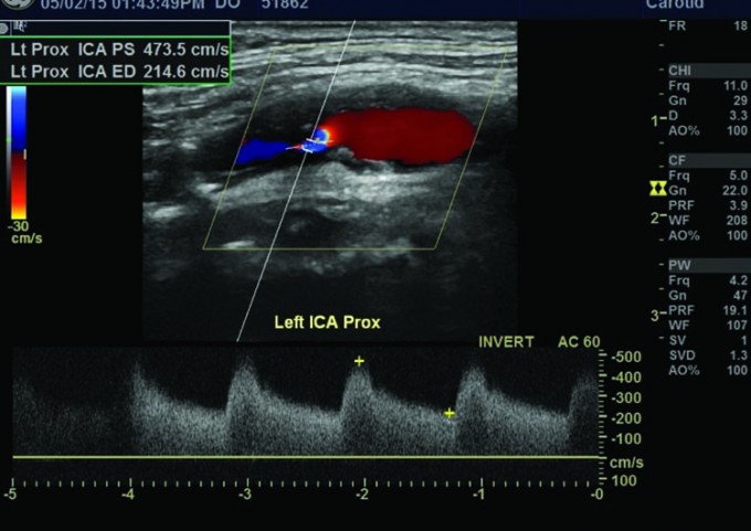 What’s new in carotid artery disease and stroke • The Medical Republic