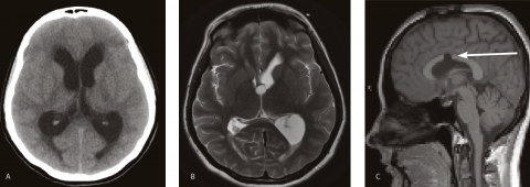 Colloid cyst of the 3rd ventricle: significance and management • The ...