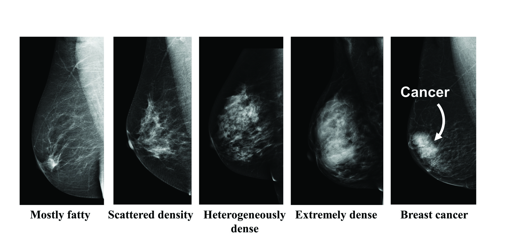 Breast Density What S All The Fuss About The Medical Republic