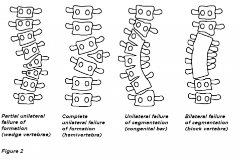 Scoliosis: diagnosis and management • The Medical Republic