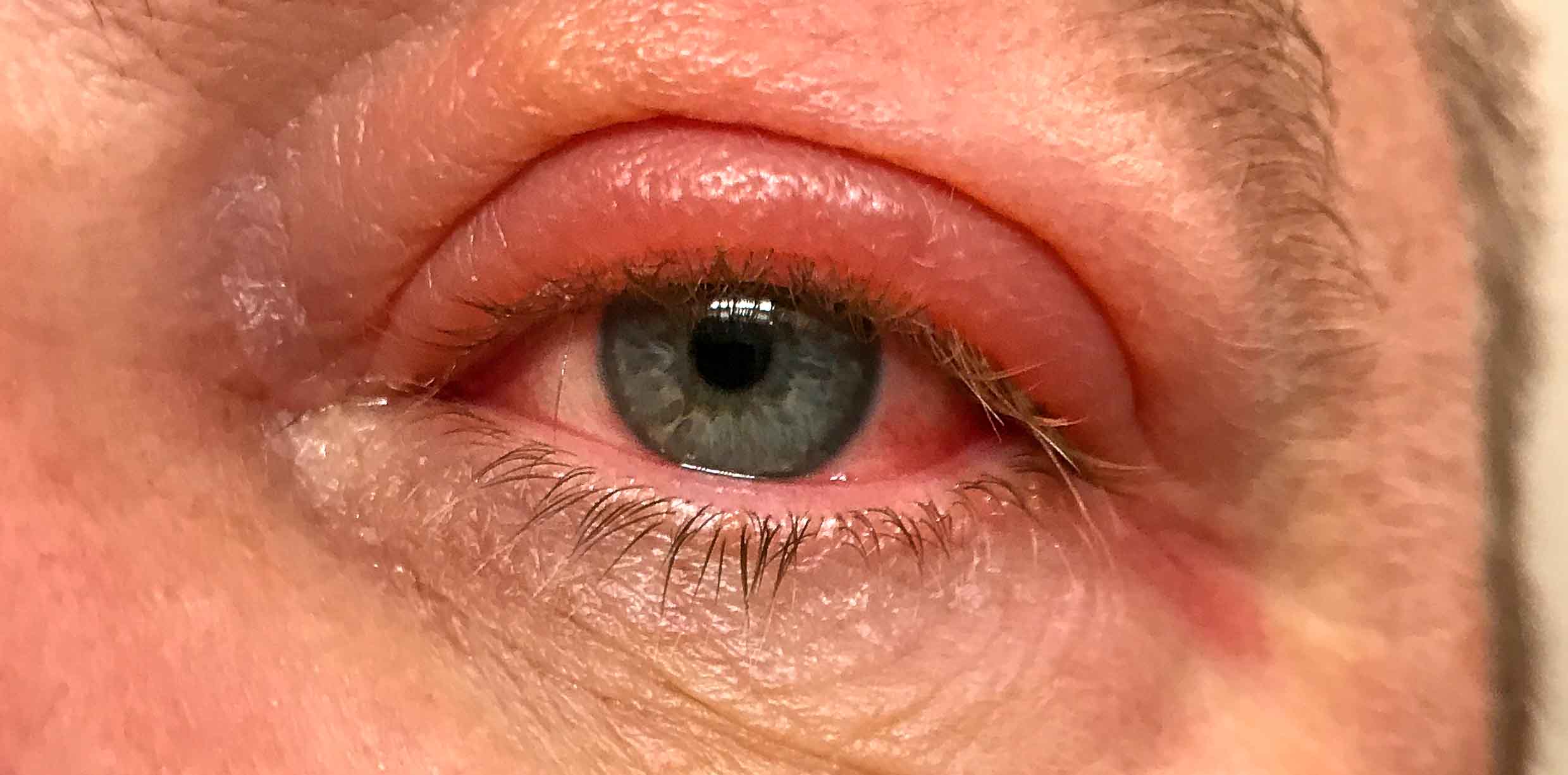 Ophthalmology Diagnosis Blepharitis Snellen Eye Chart 
