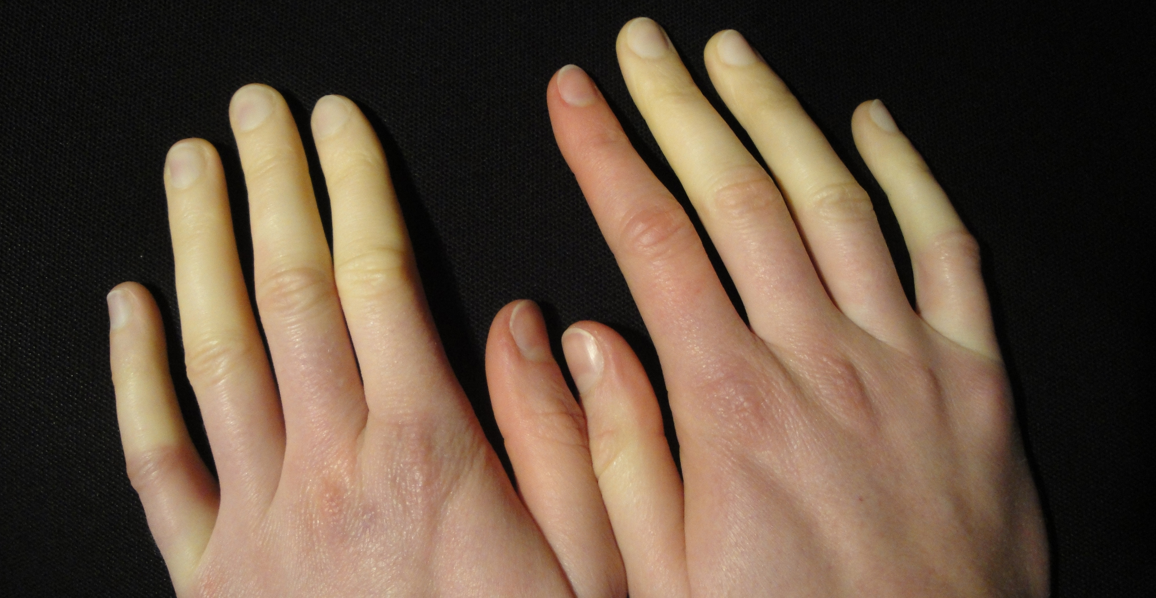Clinical clues and treatments for Raynaud’s • The Medical Republic