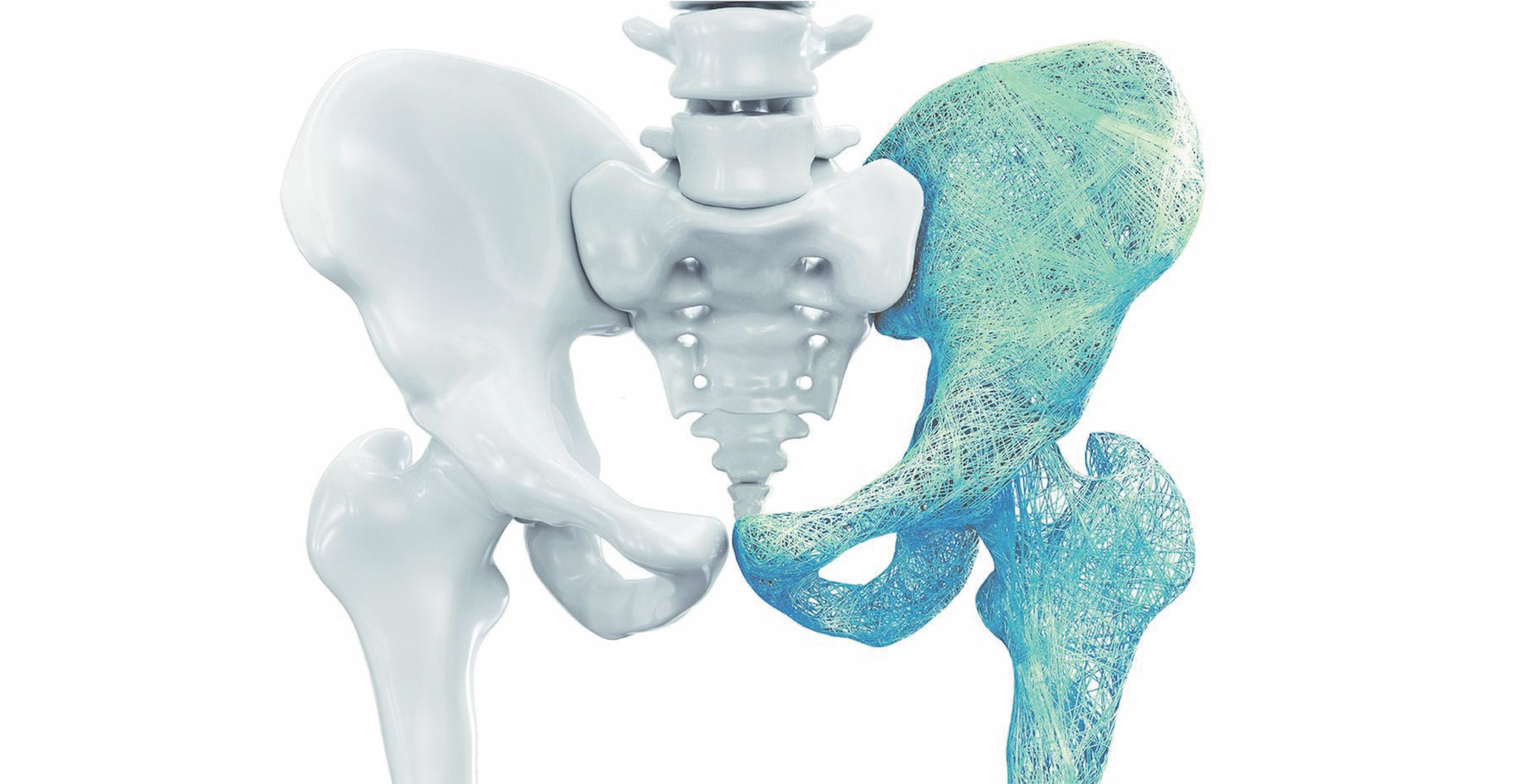 What Is Low Trauma Fracture