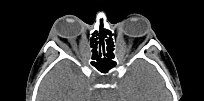 Diagnosis And Management Of Thyroid Eye Disease • The Medical Republic