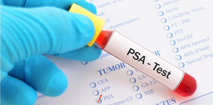 Coming up: PSA testing – an update on best practice • The Medical Republic