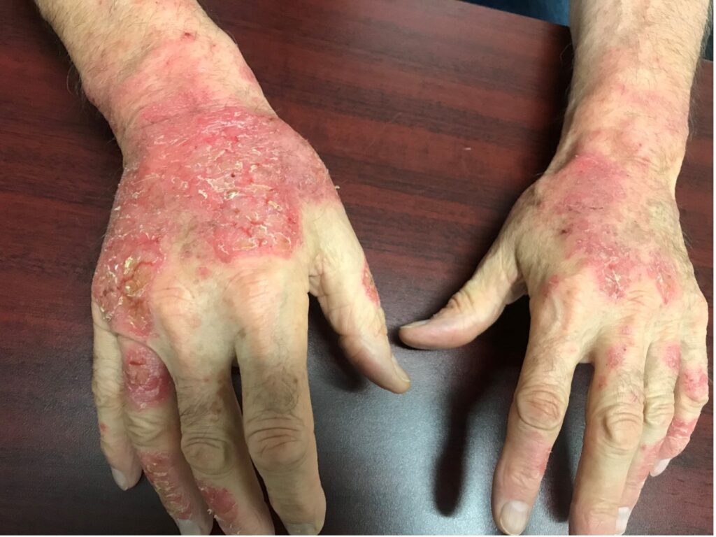 Contact allergic dermatitis