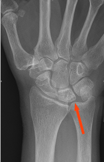 Diagnosing Ulnocarpal Abutment Syndrome • The Medical Republic 3052