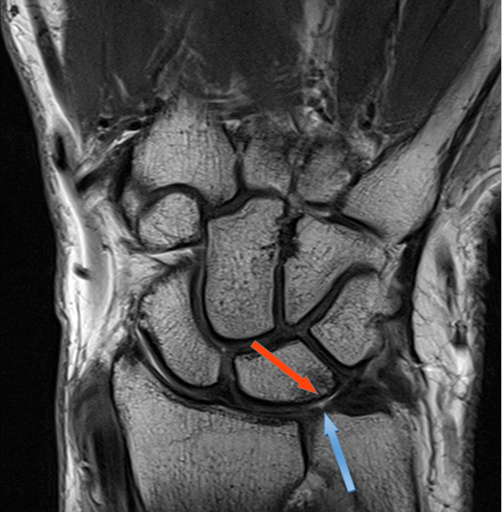 Diagnosing ulnocarpal abutment syndrome • The Medical Republic