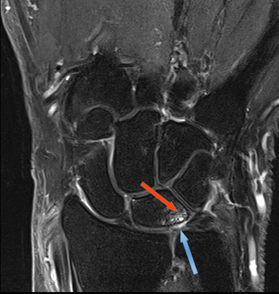 Diagnosing Ulnocarpal Abutment Syndrome • The Medical Republic 5504