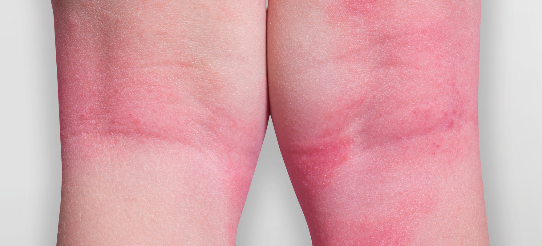 Topical corticosteroids and emollients a match for eczema • The
